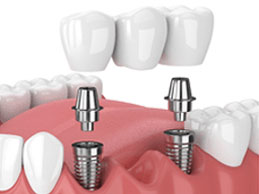 implant supported bridges