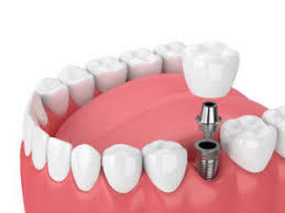 implant supported crowns