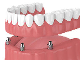 implant supported overdentures